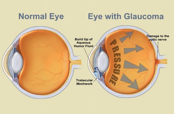Glaucoma-Eye